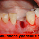 Кровь после удаления зуба