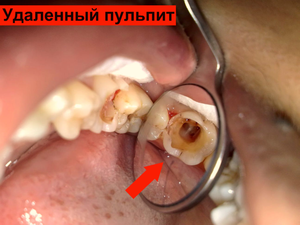 Зуб дергает и очень болит
