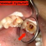 Пульпит