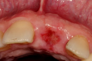 Рана после удаления зуба