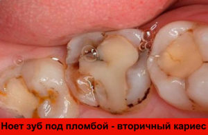 Ноет зуб под пломбой - вторичный кариес