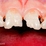 Сильно крошатся зубы фото