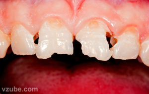 Почему крошатся зубы у взрослых: частые причины, лечение, фото