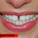 Диастема фото