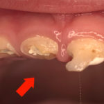 Гниет зуб фото