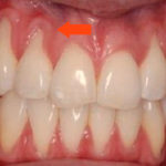 Оголилась шейка зуба фото