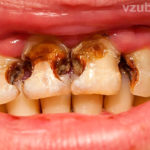 Сильно крошатся зубы фото