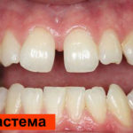 Диастема фото