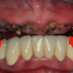 Гниет зуб фото