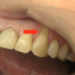 Оголилась шейка зуба фото