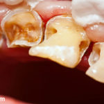 Сильно крошатся зубы фото