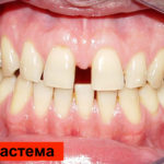 Диастема фото