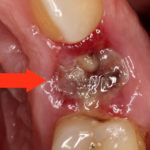 Гниет зуб фото