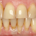 Оголилась шейка зуба фото