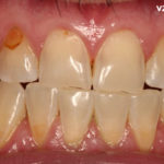 Сильно крошатся зубы фото