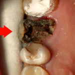 Гниет зуб фото