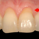 Оголилась шейка зуба фото