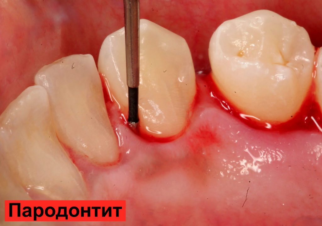 Что делают когда кровотечение зуба