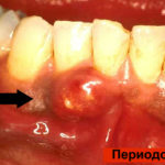 Периодонтит зуба фото