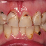 Сильно крошатся зубы фото