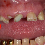 Гниет зуб фото