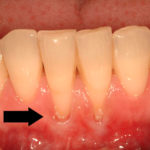 Оголилась шейка зуба фото