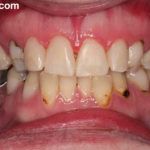 Сильно крошатся зубы фото