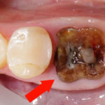 Гниет зуб фото