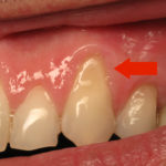 Оголилась шейка зуба фото