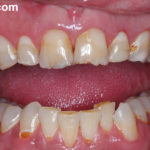 Сильно крошатся зубы фото
