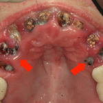 Гниет зуб фото