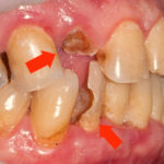 Гниет зуб фото