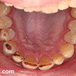 Сильно крошатся зубы фото