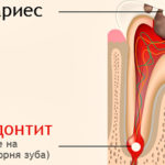 Периодонтит зуба