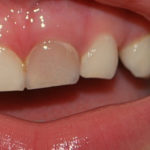 сильно потемнел зуб фото