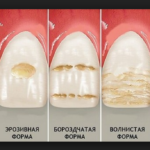 гипоплазия эмали зубов фото