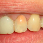 зуб стал темнее фото