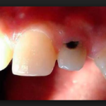кариес корня зуба фото