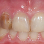 зуб стал темнеть фото