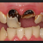 корневой кариес фото