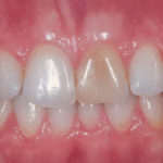 зуб меняет цвет фото