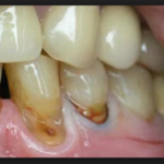 кариес на корне зуба фото