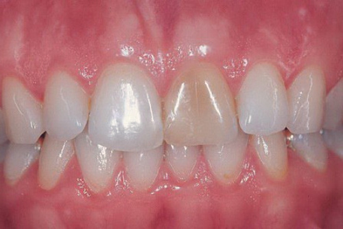 Зуб поменял цвет: фото, возможные причины и осложнения, варианты лечения