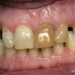 темнеет зуб фото