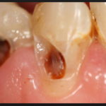 на корне зуба кариес фото