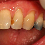 зуб поменял цвет фото