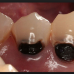 кариес корня зуба под коронкой фото