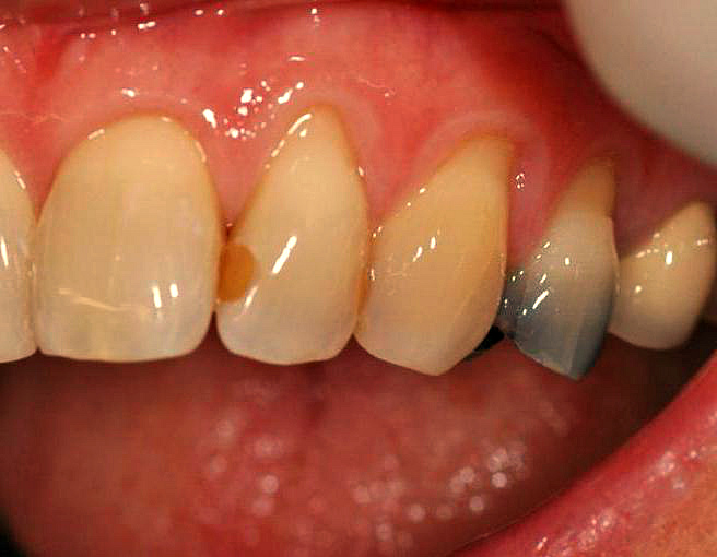 Зуб поменял цвет: фото, возможные причины и осложнения, варианты лечения