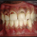 Кариес ниже уровня зуба на передних зубах фото