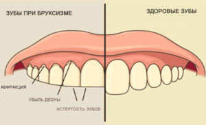 бруксизм фото